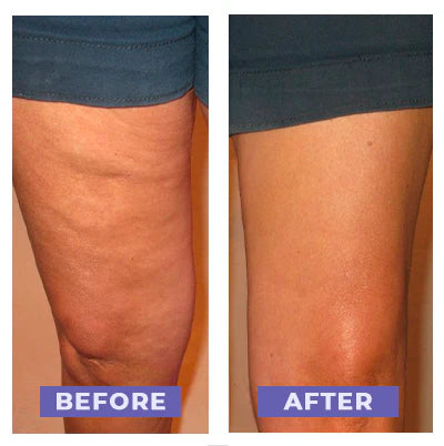 Say goodbye to cellulite, this heated cupping massager effortlessly tones and firms your skin.