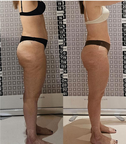 Say goodbye to cellulite, this heated cupping massager effortlessly tones and firms your skin.