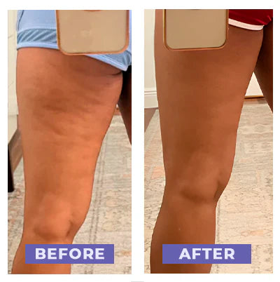 Say goodbye to cellulite, this heated cupping massager effortlessly tones and firms your skin.